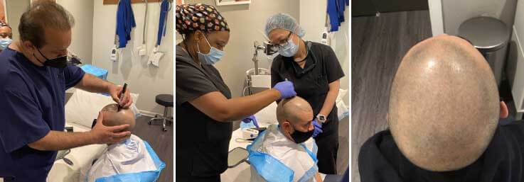 FUE hair transplant procedure midtown manhattan NYC